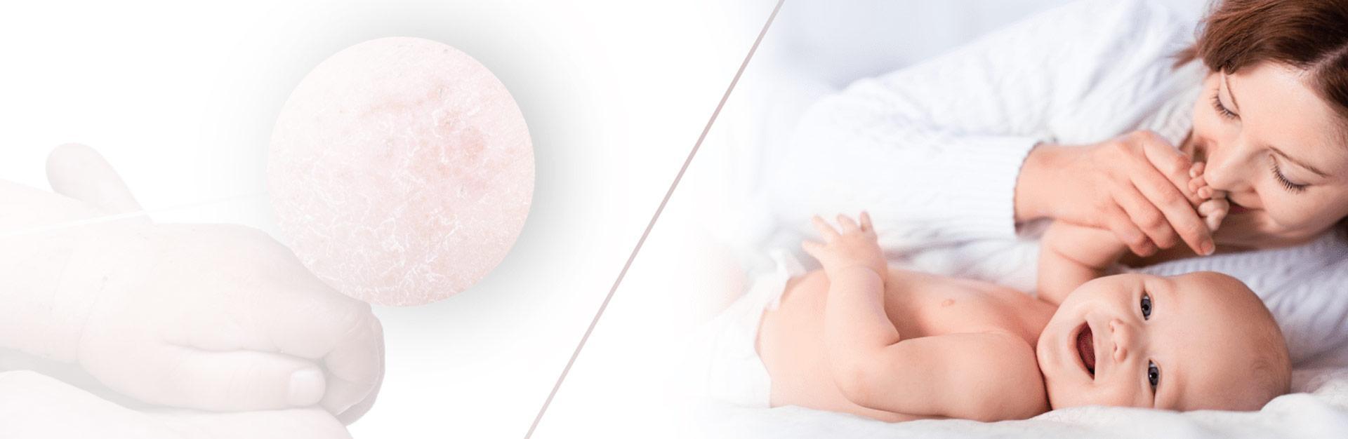 Atopic dermatitis SLIDER COM