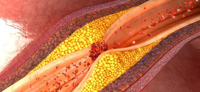 Visuel maladies cardiovasculaires